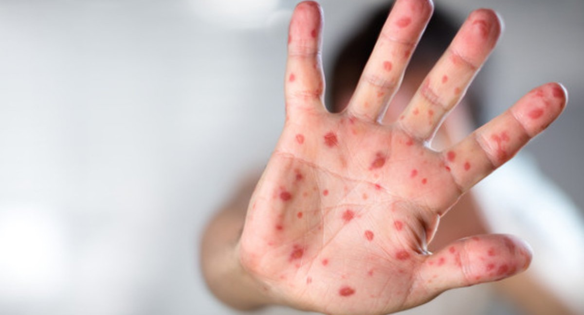 Вспышка кори в Нью-Йорке. Объявлена чрезвычайная ситуация