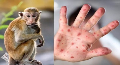 Роспотребнадзор: в России выявлен первый случай заболевания оспой обезьян
